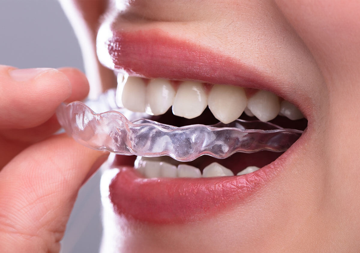 Clear Teeth Aligners in Charlotte NC Area