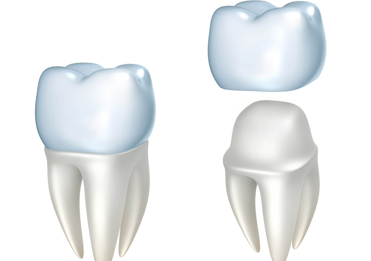 Crown for Tooth in Charlotte NC Area